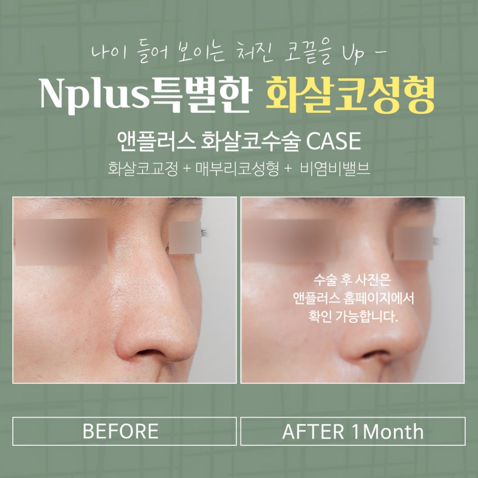 화살코성형 후기까지 확실하게 관련 이미지 16