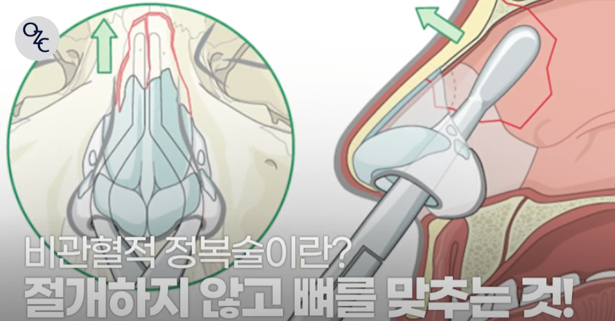 코뼈골절의 원인과 수술 방법에 대하여 관련 이미지 9