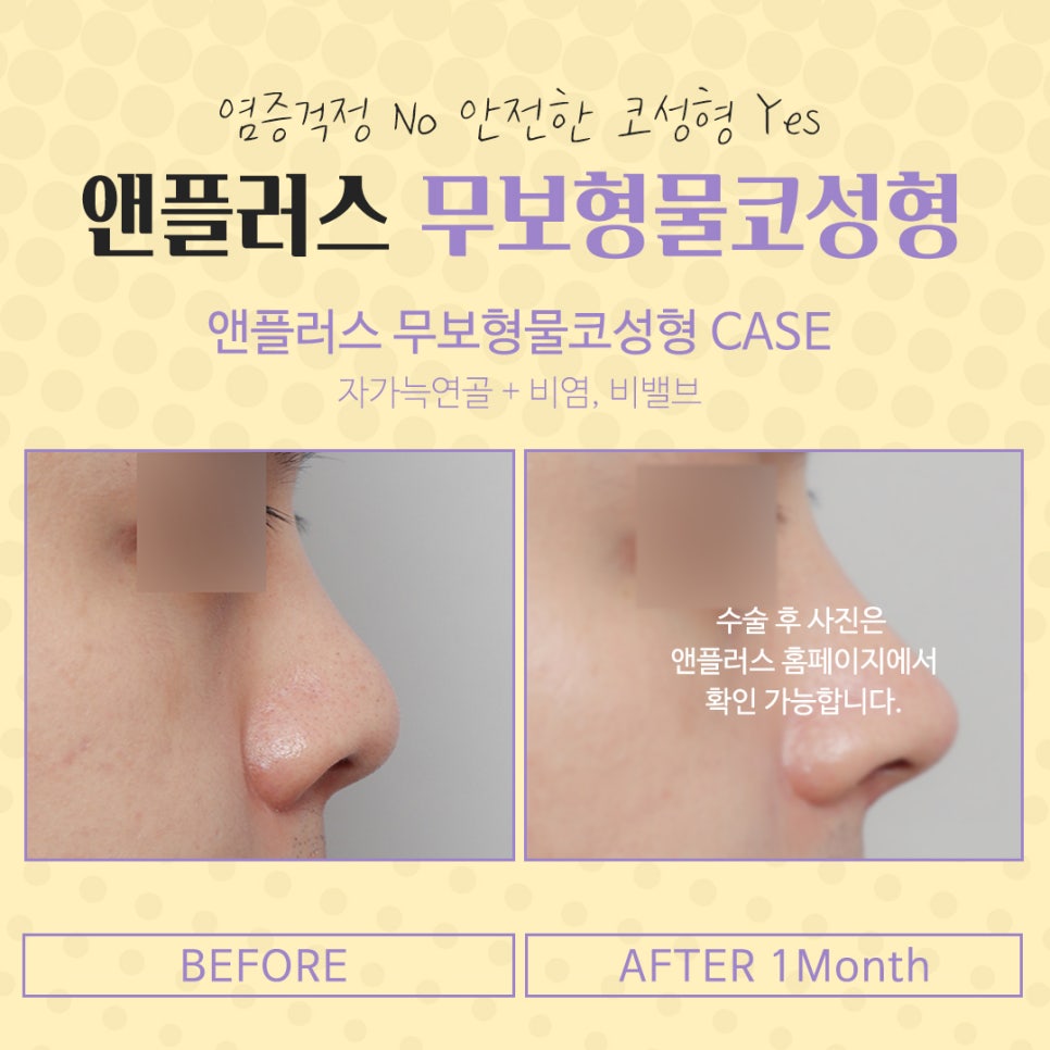 The Importance of Choosing Implant-Free Rhinoplasty image 14