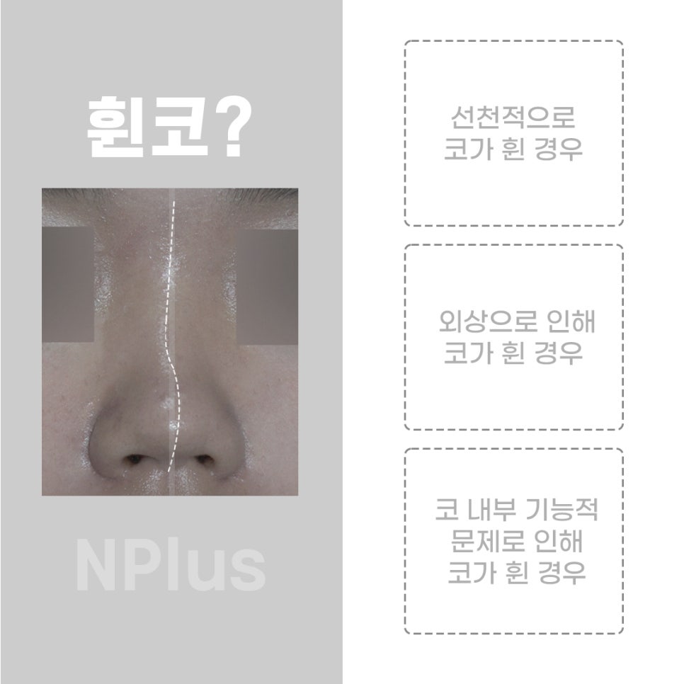 Crooked Nose Surgery Review_Confirmed Down to the Internal Structures image 3