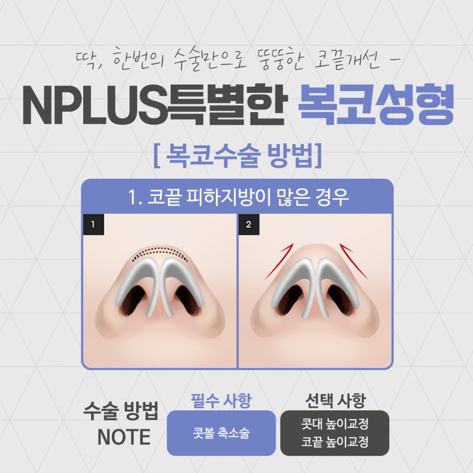 복코성형후기로 알아보는 코지방제거 관련 이미지 6