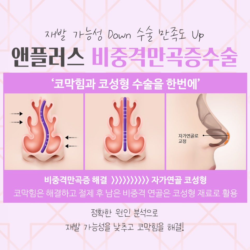 비중격만곡증수술후기 원인과 해결 방법까지 관련 이미지 8