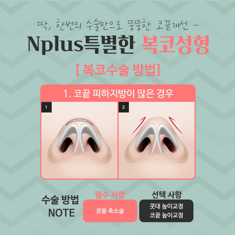 복코수술후기 세련된 인상으로 관련 이미지 8