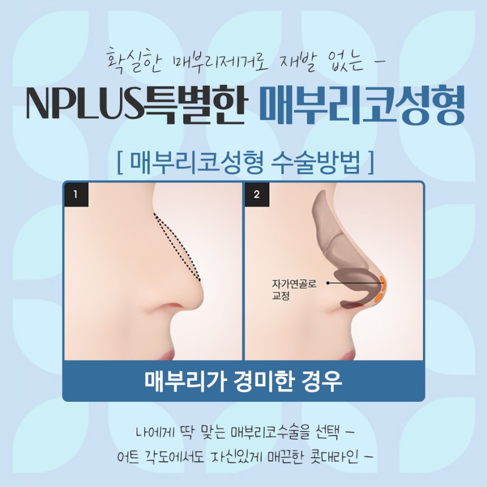 남자매부리코 원인을 정확하게 파악하고 관련 이미지 11