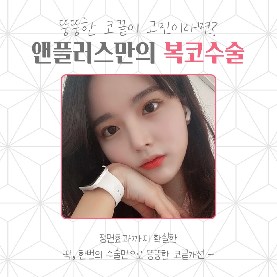복코수술후기 뚱뚱한 코끝 개선 관련 이미지 2