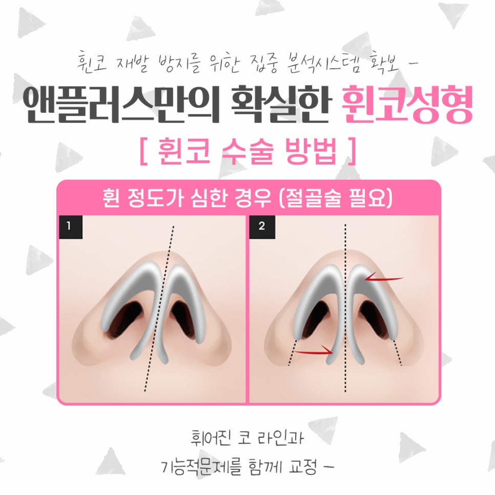 휜코수술후기를 자세하게 알아보고 관련 이미지 8