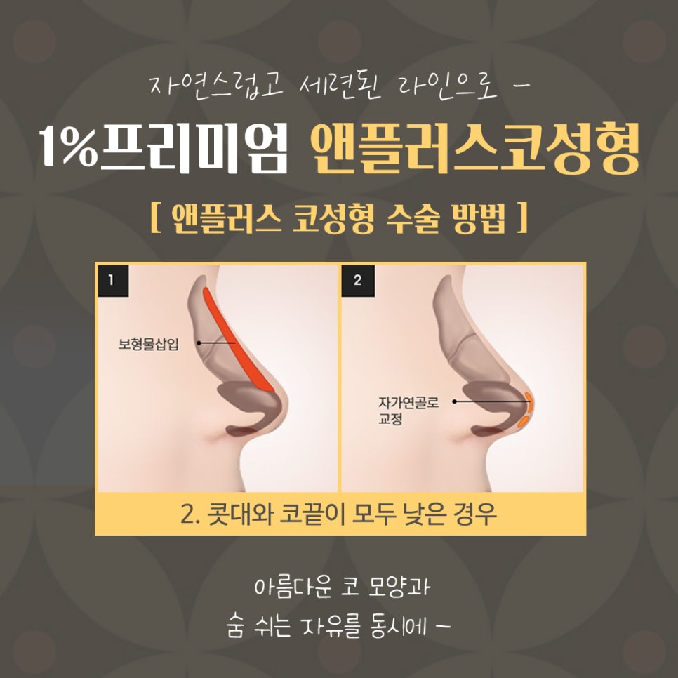 자가늑연골코성형으로 세련된 이미지로 변신 관련 이미지 9