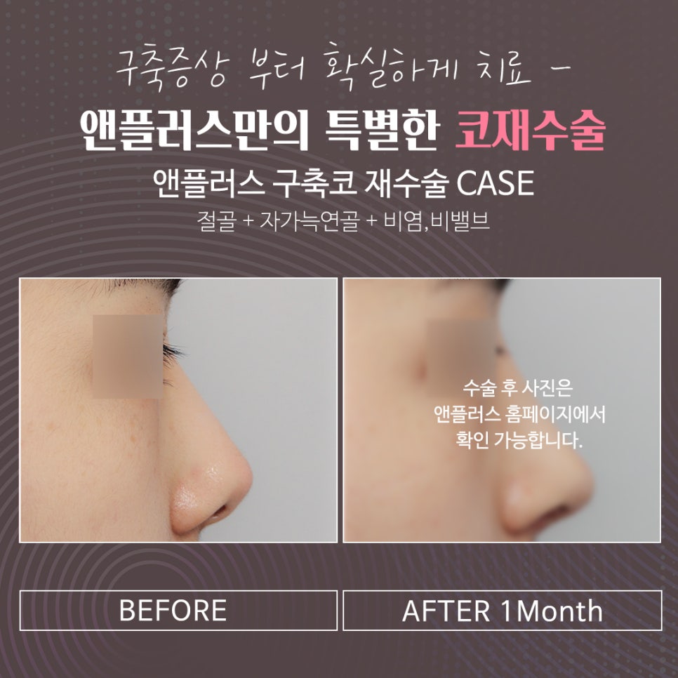 If You Develop Contracted Nose, Check Out Nose Revision Surgery Reviews! image 11