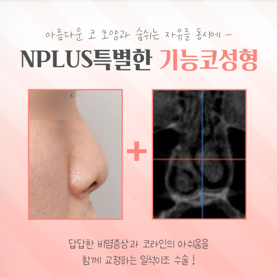 기능코성형전후를 찾아보고 관련 이미지 3