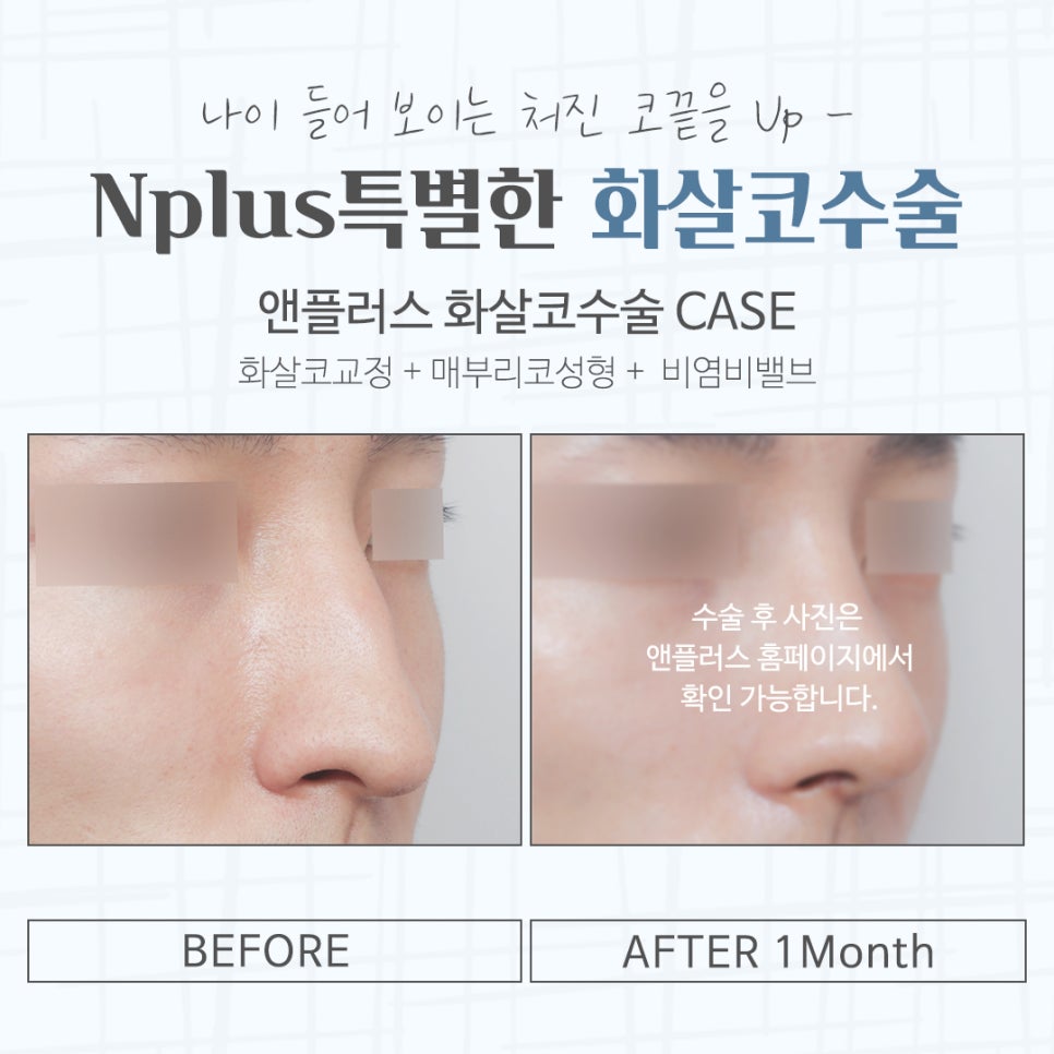 화살코수술 자세하게 알아보고 관련 이미지 16