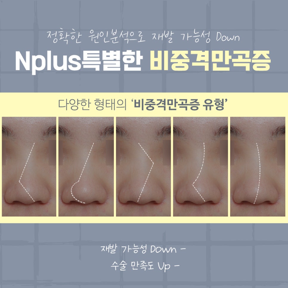 비중격만곡증수술 후기까지 확인하여 관련 이미지 7