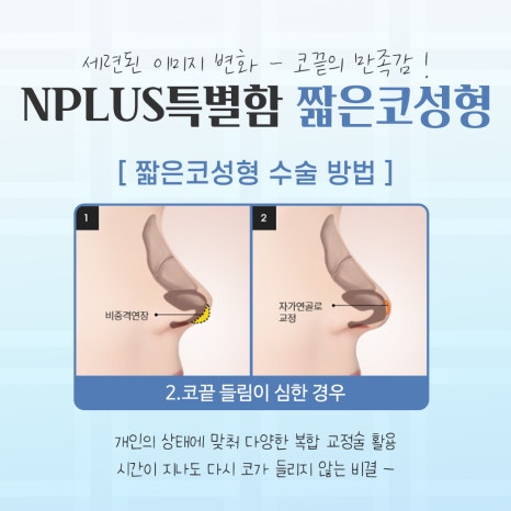 Short Nose Surgery for a Harmonious Line image 8