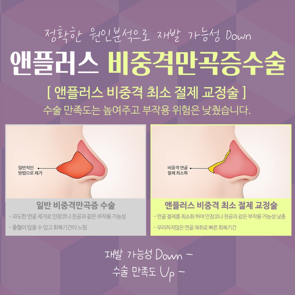 비중격만곡증수술후기 라인까지 고려해서 관련 이미지 11