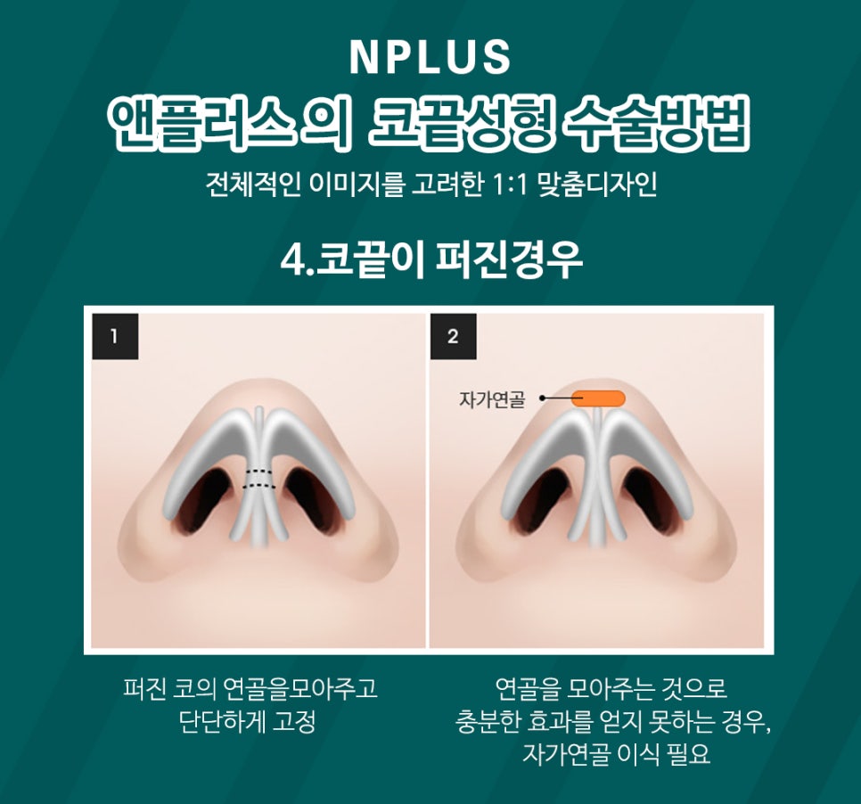 A Detailed, Careful Review of Tip Rhinoplasty image 8
