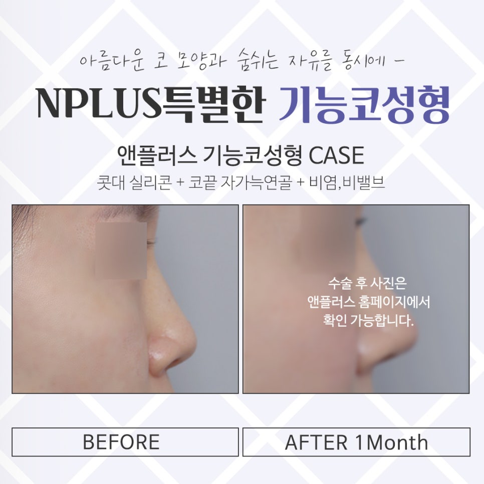 기능코수술후기 잘 알아보고 선택 관련 이미지 14