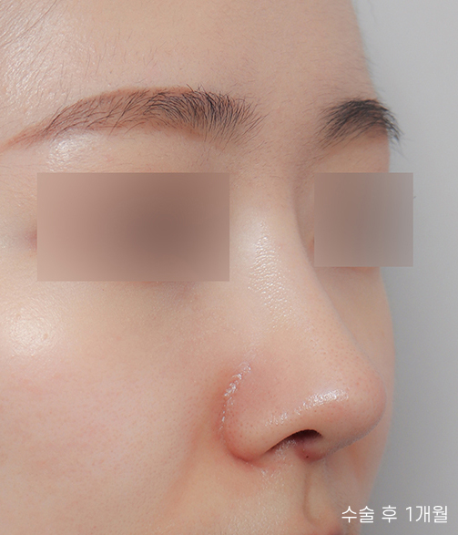 Creating a Straight-But-Slightly-Curved Nose Line with Columella Reduction image 3