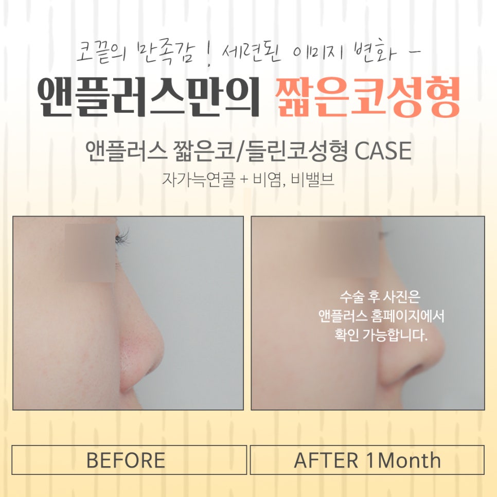 Addressing the Problems of Short Nose Surgery image 15