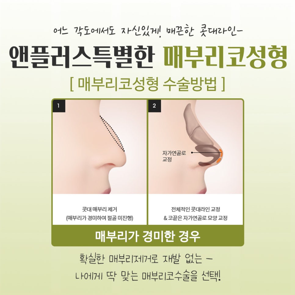 매부리코수술후기 다양한 이미지를 확인하고 관련 이미지 10
