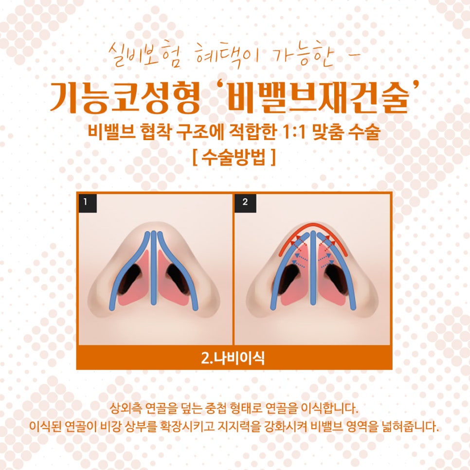 비밸브협착증 코수술방법 완벽 정리 관련 이미지 10