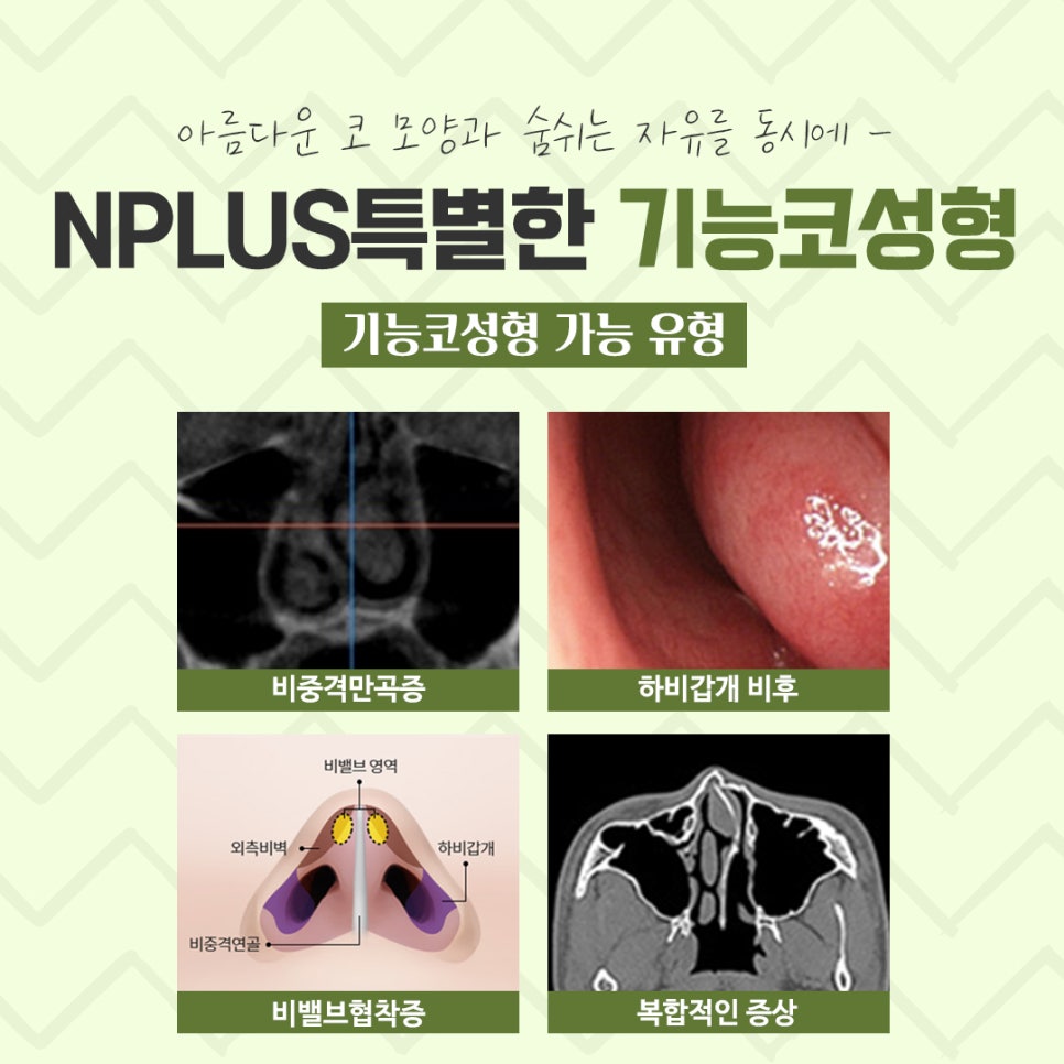 Rhinoplasty for Rhinitis at a Good ENT Clinic image 4