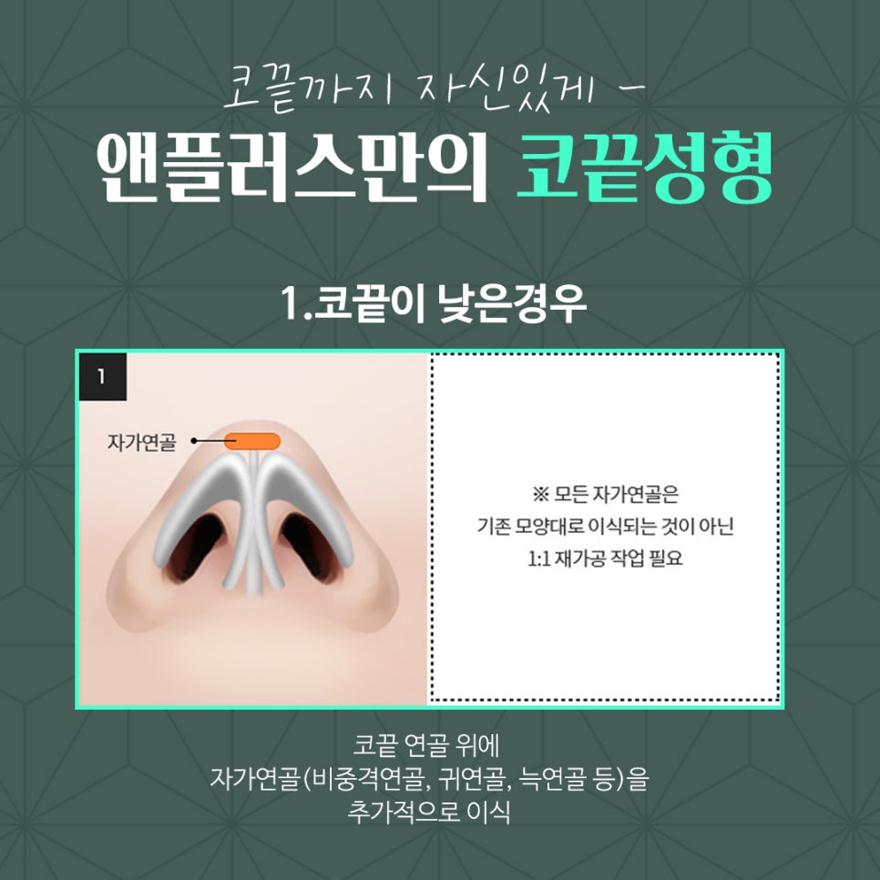 코끝연골묶기 활용한 코끝성형 관련 이미지 6