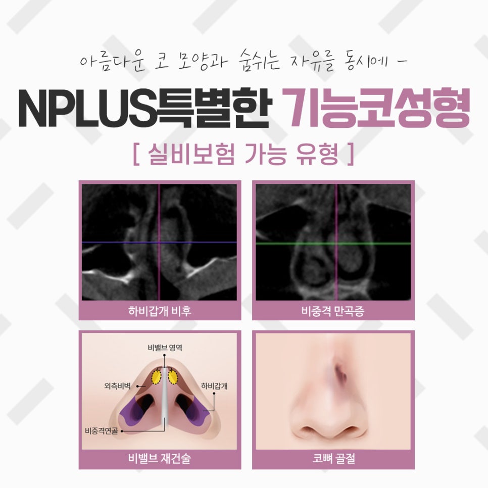 코성형실비를 알아보고 결정 관련 이미지 6