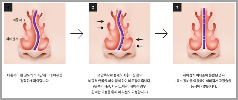 비염코성형? 어렵지 않아요. 관련 이미지 7