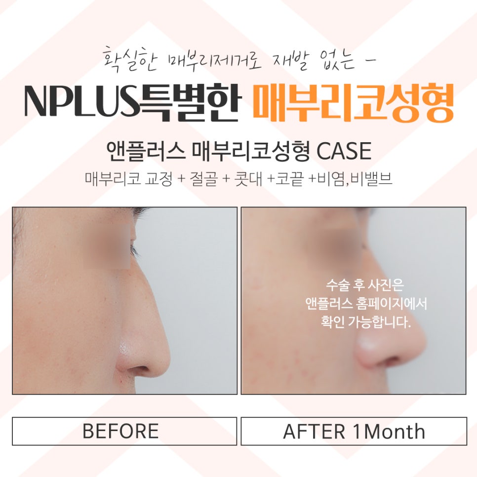 Hump Nose Surgery Review with a Clear Diagnosis image 16