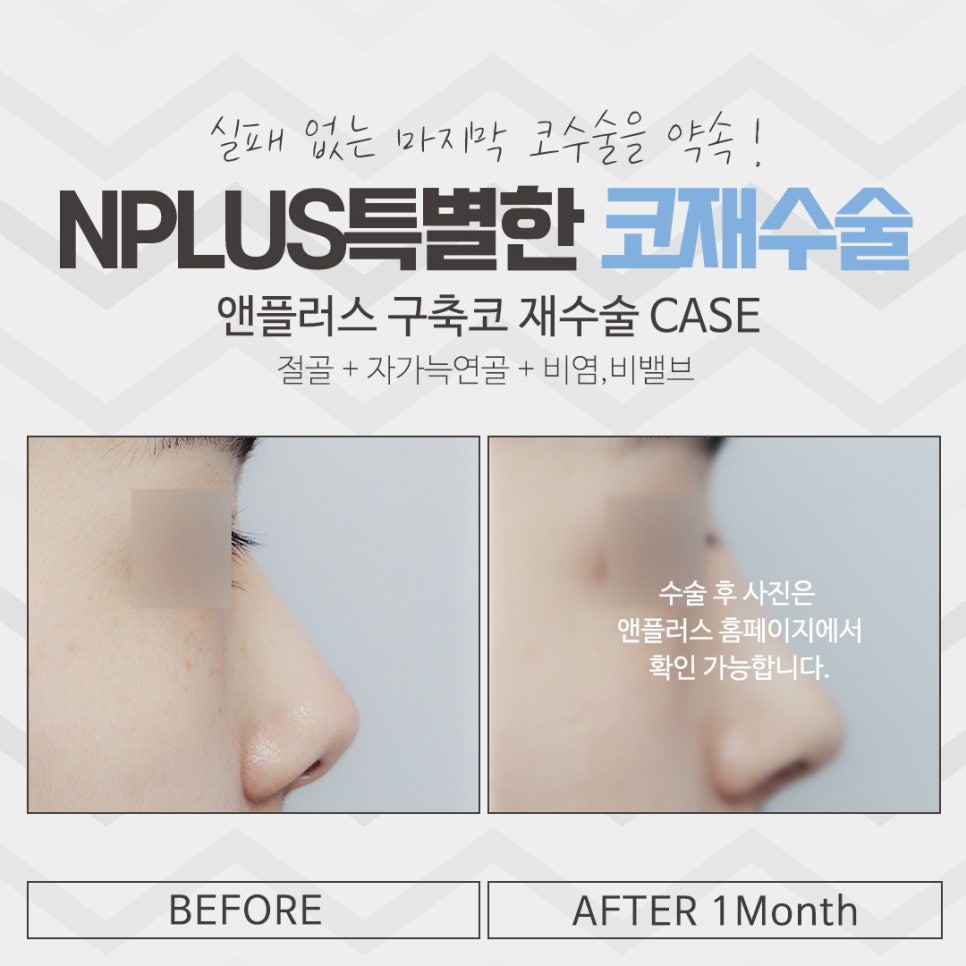 코재수술병원 자세하게 알아보고 관련 이미지 13