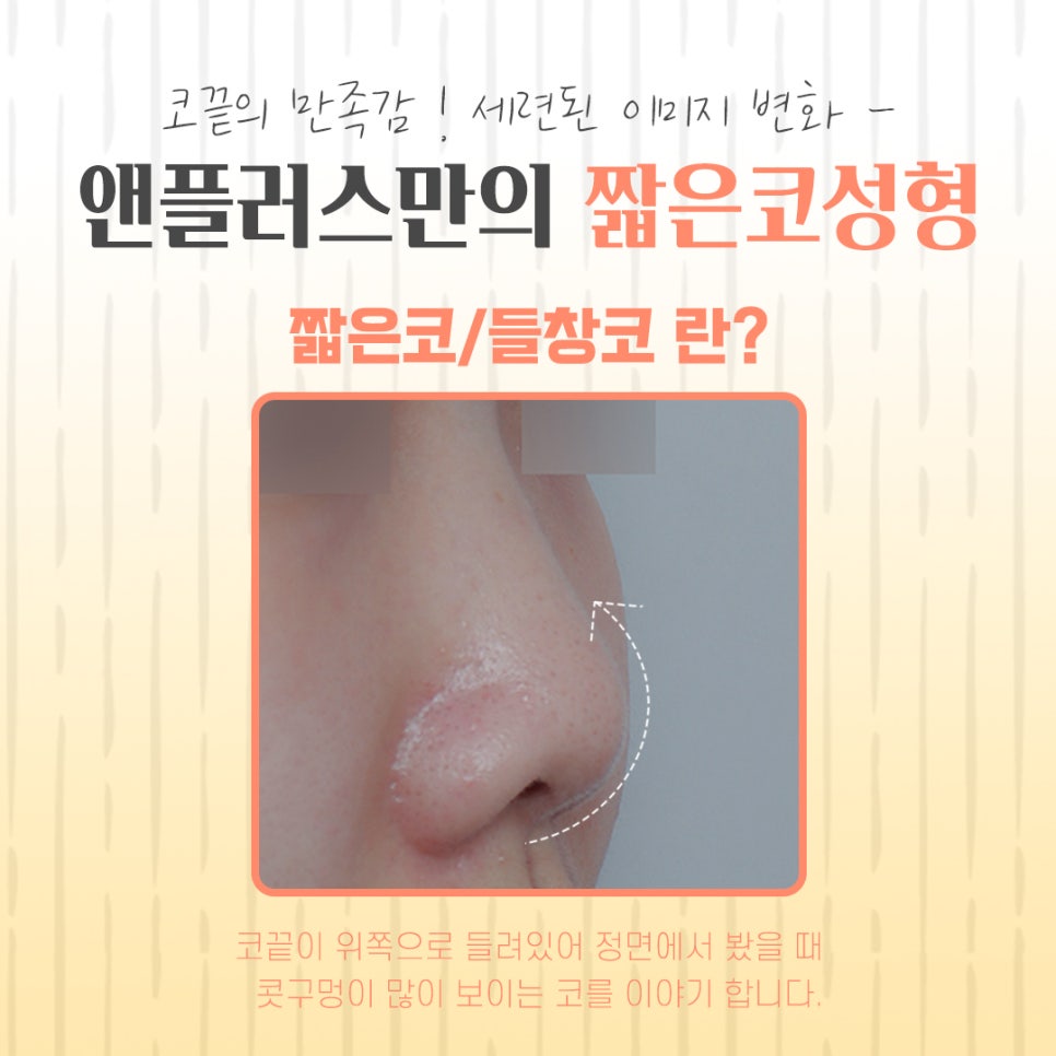 Addressing the Problems of Short Nose Surgery image 3