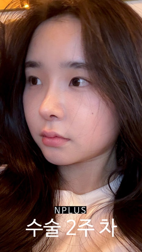 AN Plus Plastic Surgery Review: Silicone Nasal Bridge, Autologous Rib Cartilage Nasal Tip, Under-Eye Fat Repositioning, Fat Grafting image 6