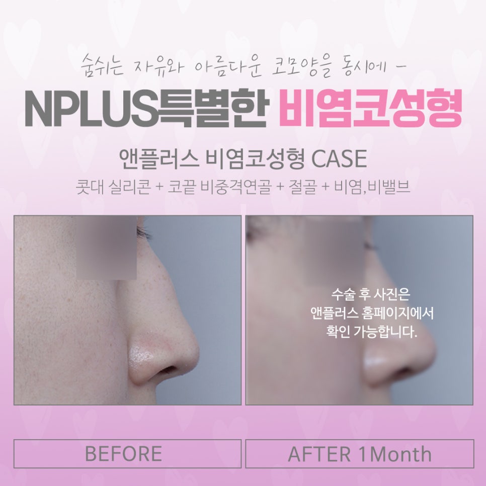 Learn in Detail About Rhinoplasty for Rhinitis image 14