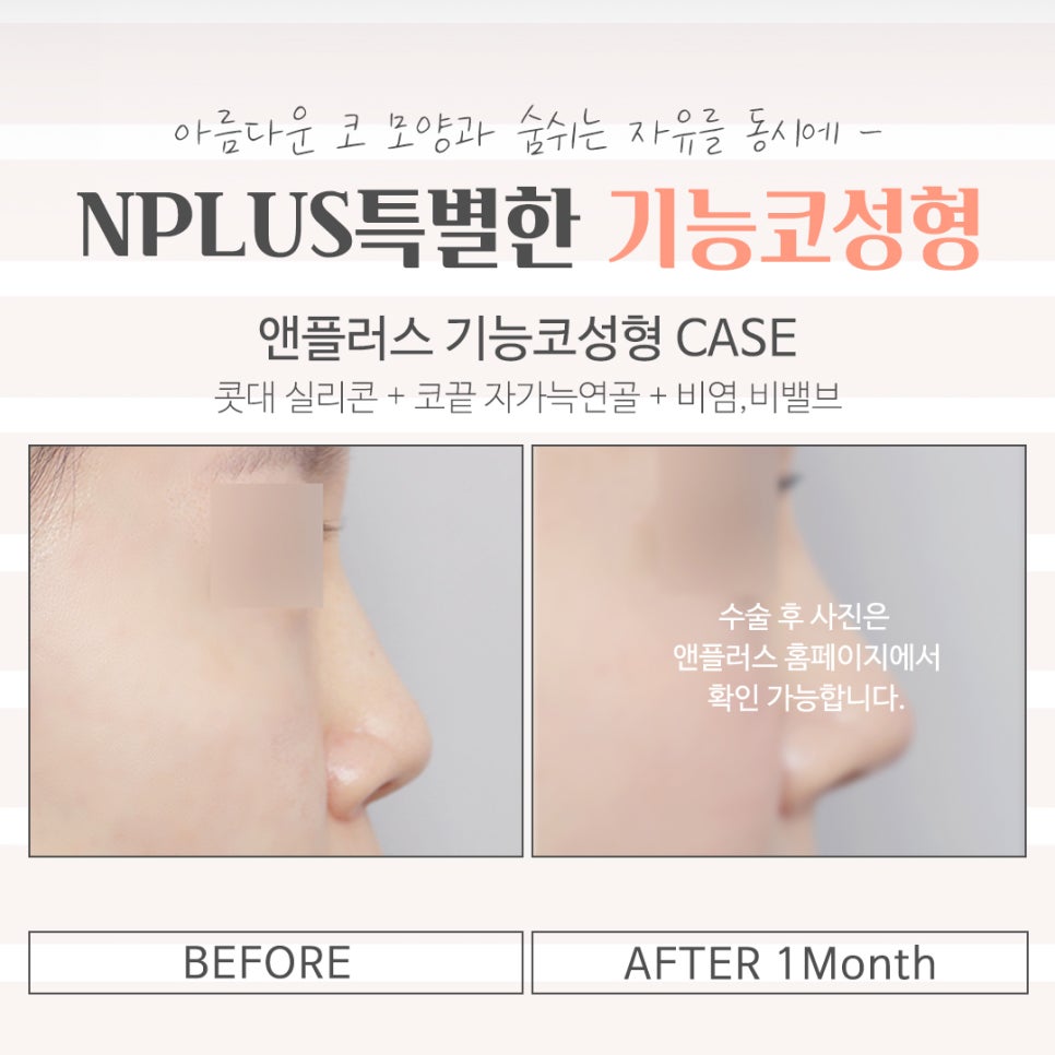 기능코성형후기에 대해 상세히 알아보고 관련 이미지 15