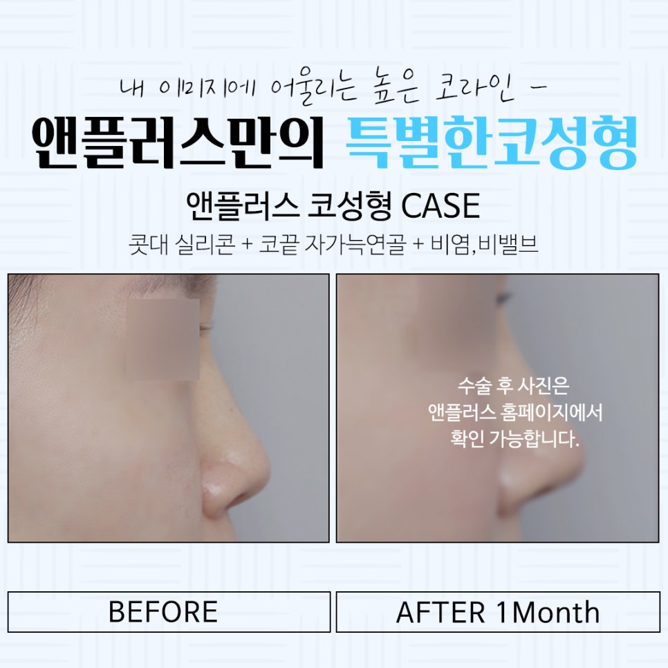 Learn About Autologous Cartilage Rhinoplasty image 15