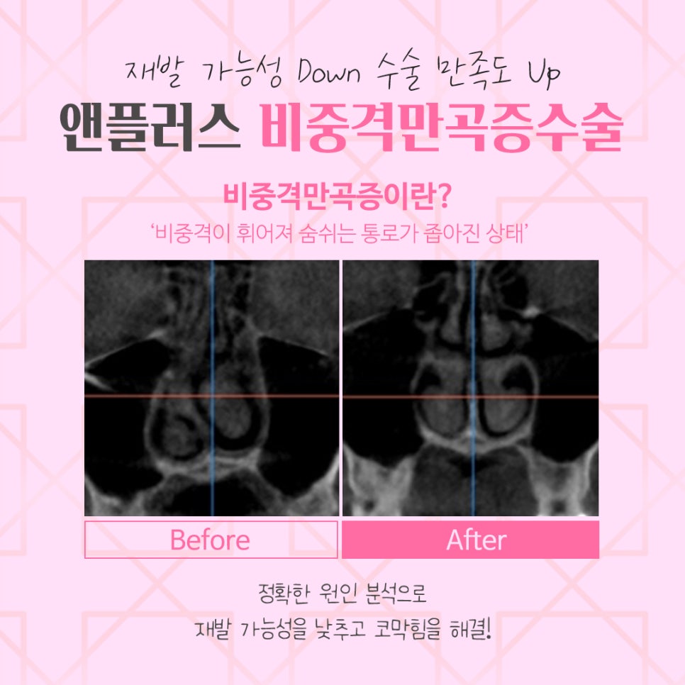 Septoplasty Surgery Review: It’s Important to Identify the Exact Cause image 4