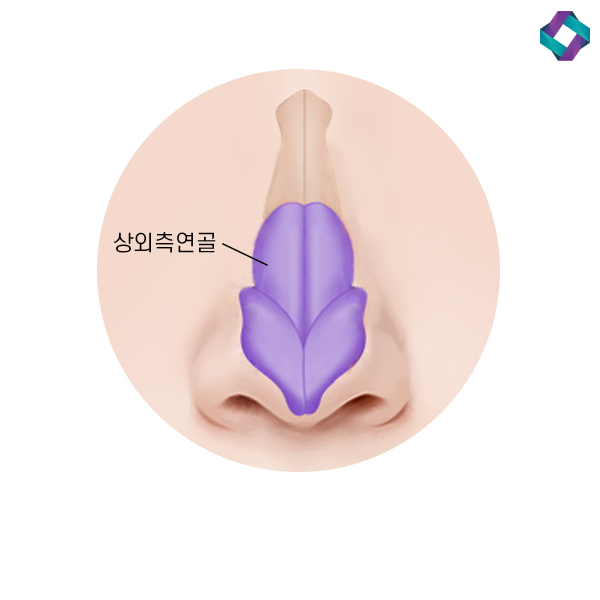 비염수술코성형 비밸브 교정술! 관련 이미지 11