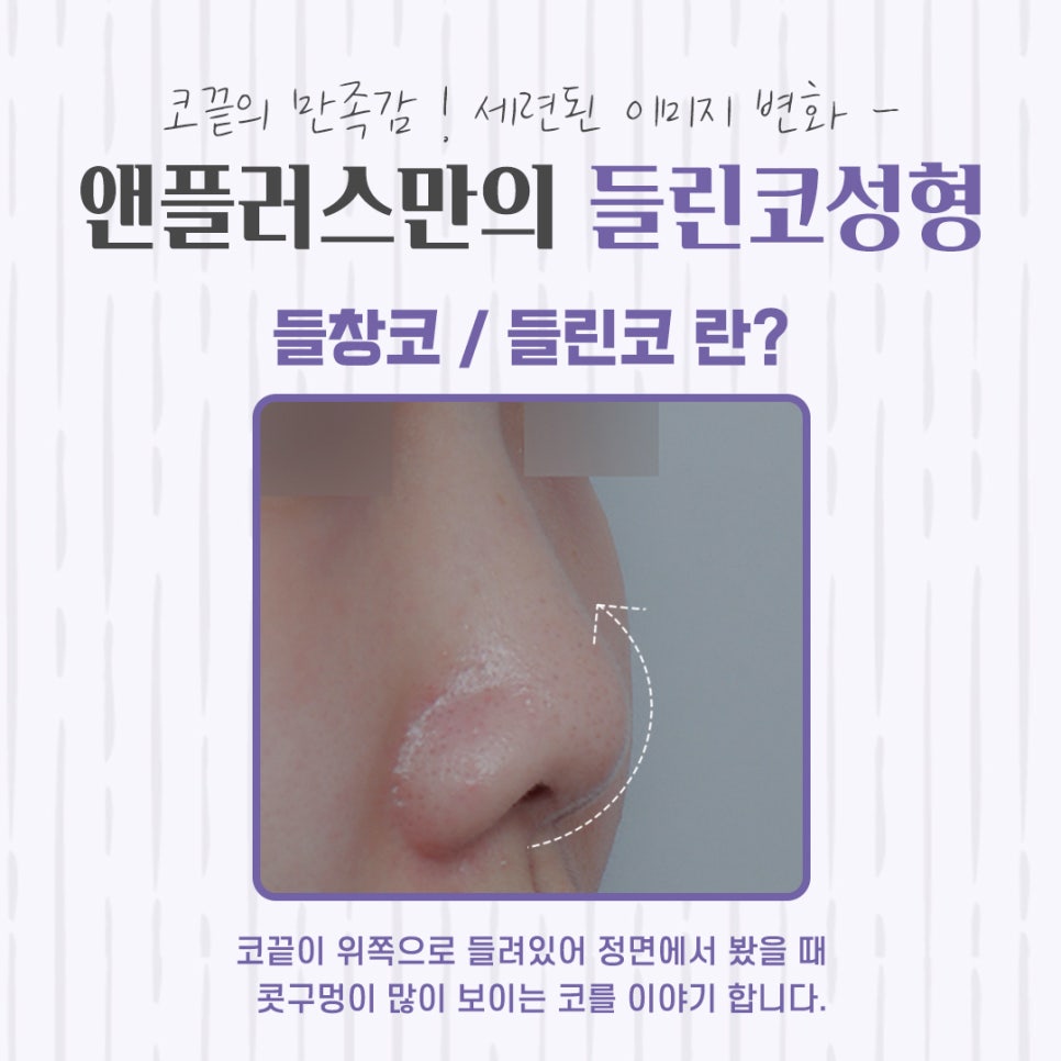 A Clear Correction After Upturned Nose Surgery Review image 4