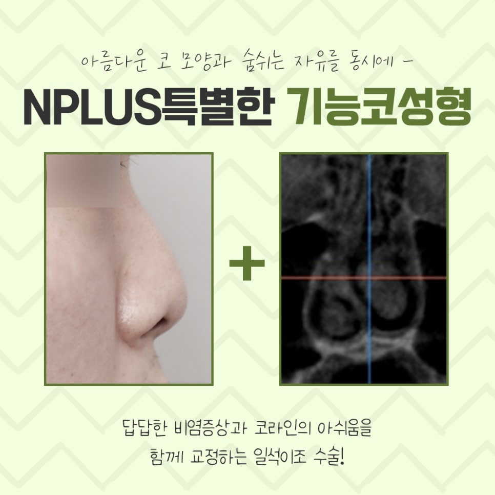 Rhinoplasty for Rhinitis at a Good ENT Clinic image 3