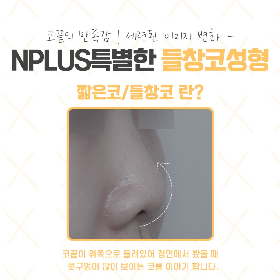 들창코수술에 대해 자세하게 알아보고 관련 이미지 4