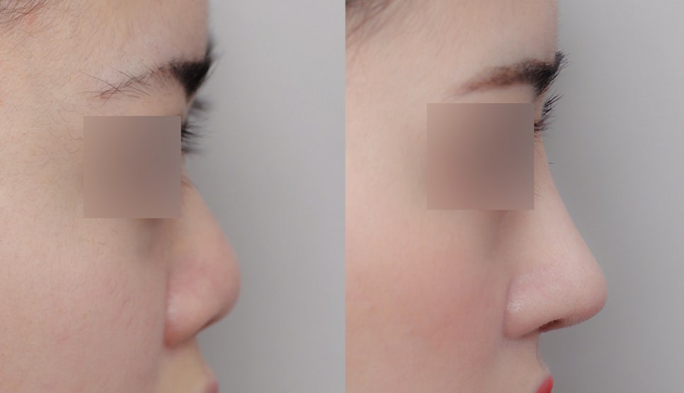 Upturned Nose Surgery_Naturally with Tip Lengthening image 1