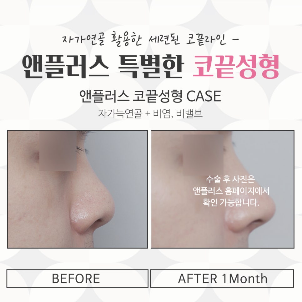 코끝수술후기의 다양함을 알아보고 관련 이미지 15