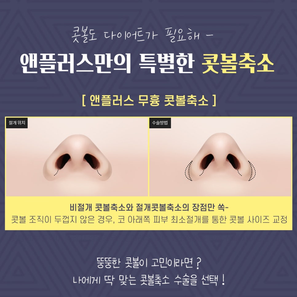 Non-Scar Alar Reduction to Improve a Bulbous Nose image 5
