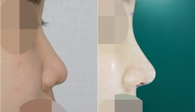 코재수술 (콧대+코끝+비주내리기) 관련 이미지 1