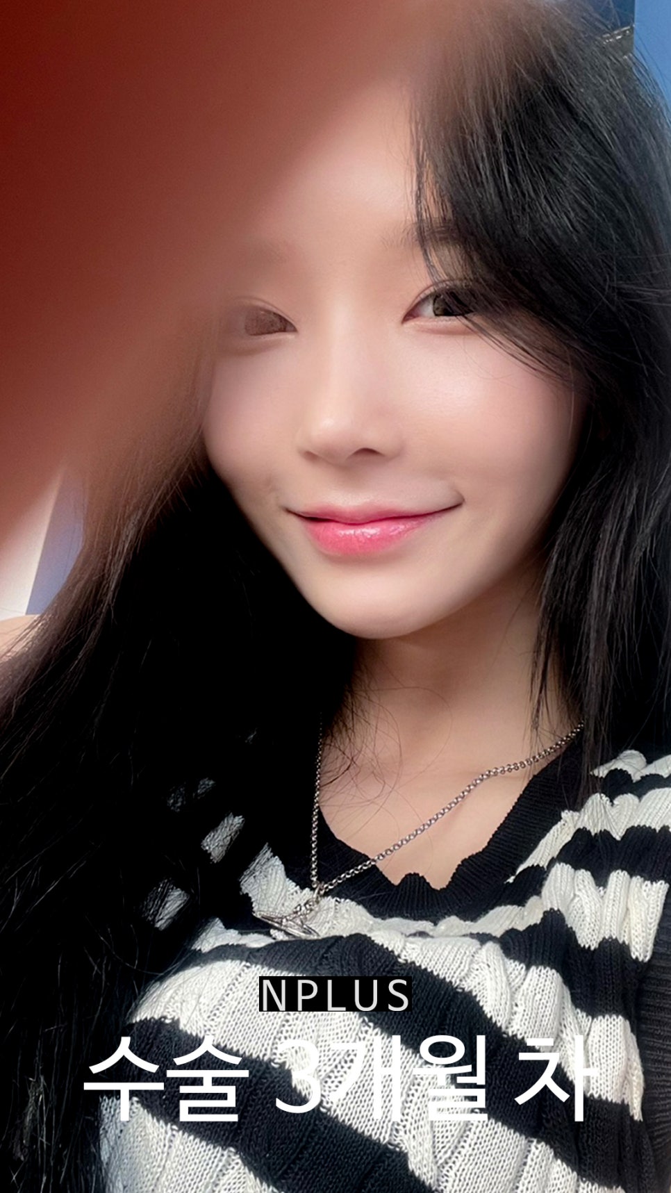 기본코성형후기 절골 + 무보형물 코성형 + 코끝 비중격 연골, 귀 연골 관련 이미지 10