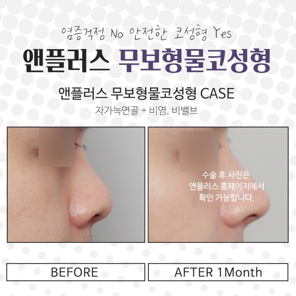 Accurately Check Non-Implant Rhinoplasty image 14