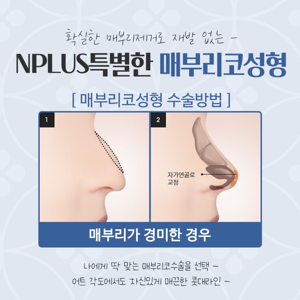 Hump Nose Surgery Review with an Accurate Diagnosis image 11