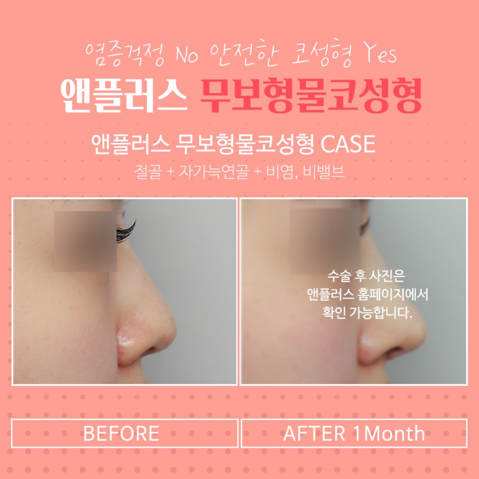무보형물코수술 안전하고 자연스럽게 관련 이미지 4