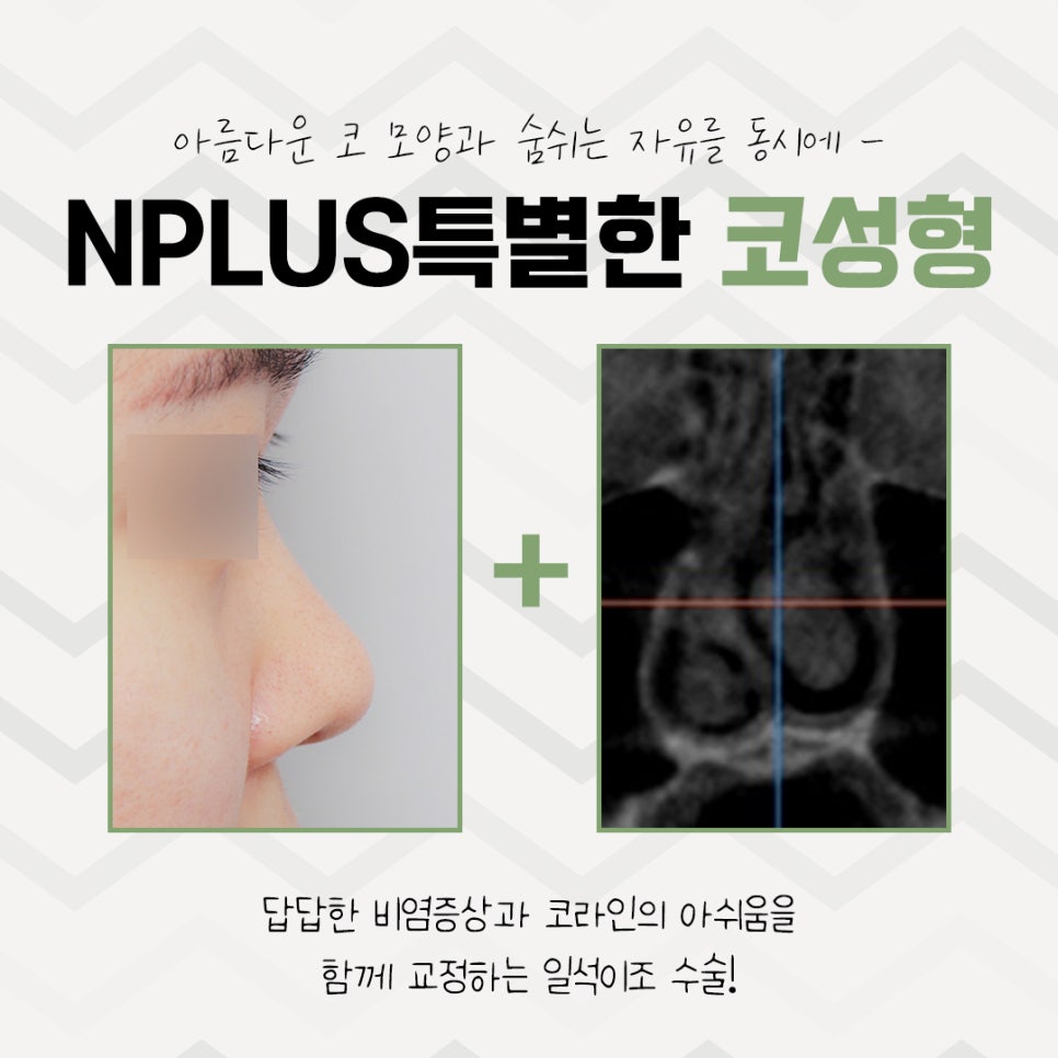 코수술전후 확실한 차이를 알아보고 관련 이미지 7