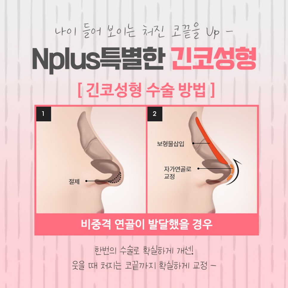 긴코성형 자연스럽게 교정하여 관련 이미지 7