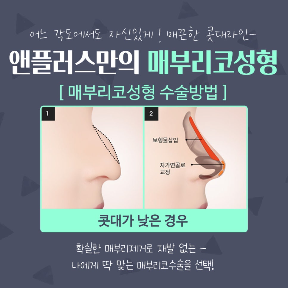 매부리코성형후기 매끈하고 예쁜코라인으로 관련 이미지 9